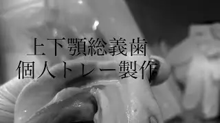 上下顎総義歯個人トレー製作　2症例目