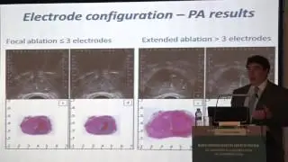 Dr Jean de la Rosete Focal treatment: Treatment alternatives. Electroporation