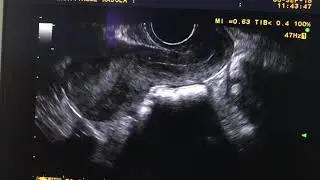Enlarged cervix in grand multipara