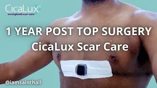 Top Surgery - Scar Healing Update with CicaLux