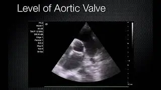 Focused Cardiac Ultrasound by Bon Ku, MD, MPP   SD