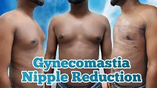 Gynecomastia & Nipple Reduction Surgery || পুরুষের বড় স্তন 