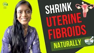 Shrink Uterine Fibroid with Ayurvedic Natural Treatment | 10 Best Herbs, Yoga and Diet Tips