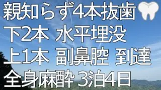 親知らず4本抜歯～全身麻酔～
