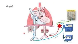 Diferential cyanosis VAV and Axillary VA ECMO Animation