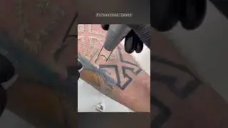 removing old tattoos with picosecond laser💀