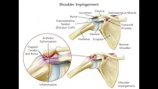 Subacromial decompression; surgical procedure used to treat shoulder impingement syndrome