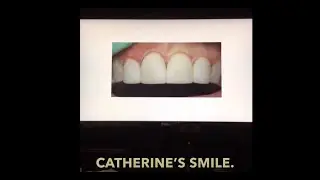 Trimming and Contouring of Bioclear Uveneers: Get The Ideal and Natural Shapes | Part 8