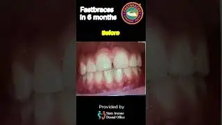 Fastbraces before and after