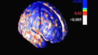 Progressive Cortical Thinning in Alzheimer's disease patients