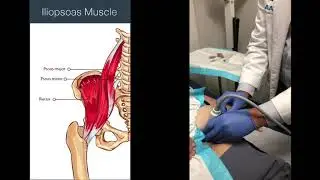 Ultrasound Guided Hip Injection- Claim 1 CME Credit for Reflecting on Video