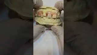 Flexible Dentures #dentist  #FlexibleDentures #dentalartistry #flexiblepartialdentures  #dentures