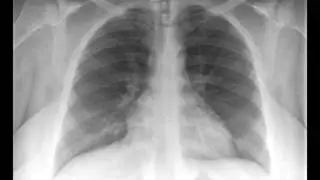 Normal Chest PA and Lateral