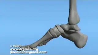 Cole Osteotomy Surgical Procedure of Mid Foot
