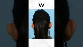 Pin your ears back to correct ear protrusion, position and shape with an Otoplasty procedure!