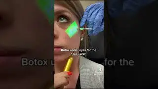 Botox for Jelly Roll
