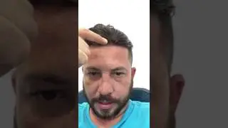 Hair Replacement Men's hair system review 1.5 months