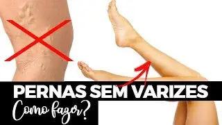 6 REMÉDIOS CASEIROS PARA TER PERNAS SEM VARIZES | Dr Dayan Siebra