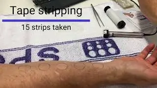 Tape stripping