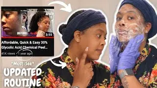 Safe, Affordable, Quick & Easy Chemical Peel for Hyperpigmentation | Beginner & Black Skin Friendly