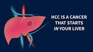 Primary Liver Cancer - Understanding HCC