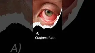 Pink Eye Infection Q01 of 50 | #medisciquizzes #healthyliving
