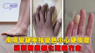 皮膚變硬手指變色小心硬皮症 搞到肺纖維化隨時冇命 ｜ 健康關注組 ｜ EP507 ｜ 硬皮症 ｜ 肺纖維化 ｜ 手指變色 ｜ 皮膚變硬 ｜ 吳雲甫 ｜ 黃芳雯 ｜ HOY TV 77台