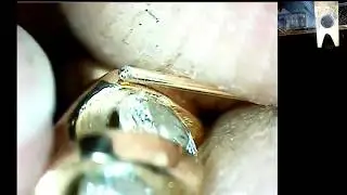 S CHANNEL PRONG REPAIR