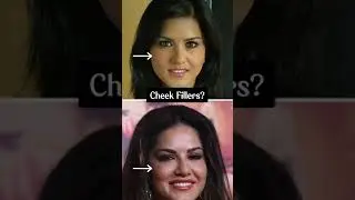 Sunny Leone Plastic Surgery ?