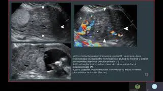 Adenomiosis en Embarazo