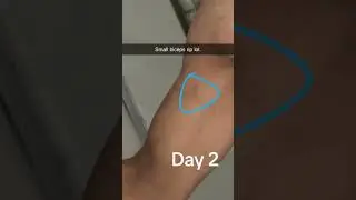 Bicep Tear Injury 💔