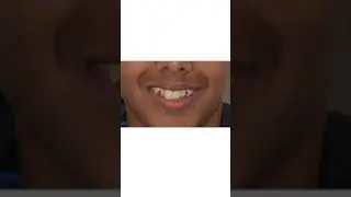 Smile Transformation - Crowded teeth