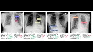 [P010] Robust Detection Outcome: A Metric for Pathology Detection in Medical Images