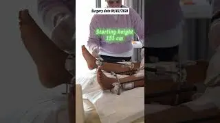 Day 4 After Limb Lengthening Surgery Height Increase Surgery | Limb Lengthening Surgery in India