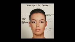 Botox FABFEB specials! #botox #smoothness #headacherelief #migrainerelief #nomorewrinkles #madsmiles