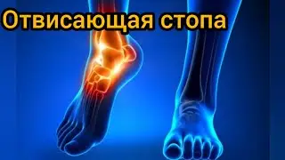 19. Артроз & Остеохондроз. Отвисающая стопа / эквинус / парез малоберцового нерва / нейропатия
