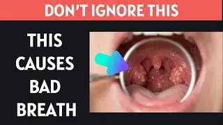 White Bumps in Throat? Are They Tonsil Stones? (Fix Guide)