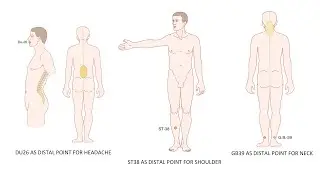USE OF DISTAL ACUPOINTS FOR CHANNEL PROBLEMS