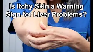 Is Itchy Skin a Warning Sign for Liver Problems?