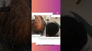 Stem cell activation for hair loss results #dlapp #baldnesstreatment #stemcelltherapy #trending