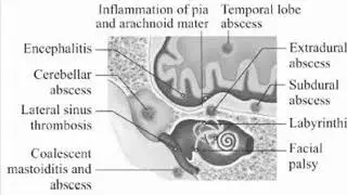 ROUTE OF INTRACRANIAL SPREAD OF CSOM