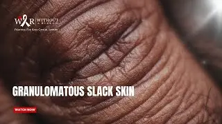 Granulomatous Slack Skin