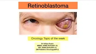 Retinoblastoma for NEET PG