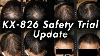 Обновление информации о препарате KX826 от выпадения волос: долгосрочные испытания безопасности, ...