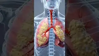Chest Infection Explained 3D Medical Animation