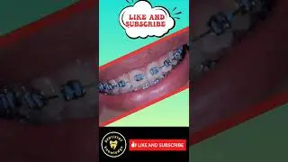 #dentistryknowledge#dentist#world#tooth#bridge#restoration#smile#shorts#youtube#viral#top#instagram#