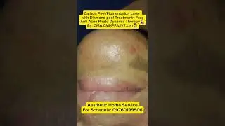 Pigmentation Laser/Carbon Peel/Diamond peel and PDT Treatment 