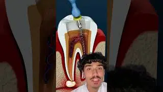 COMO &Eacute; FEITO TRATAMENTO DE CANAL ?