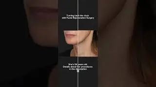 Facelift & Neck Lift by Expert Facial Plastic Surgeon Dr. Maia in Washington D.C. | #facelift