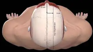 EVD insertion